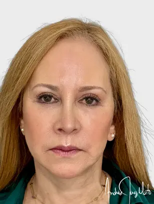 Resultado 1 - Después