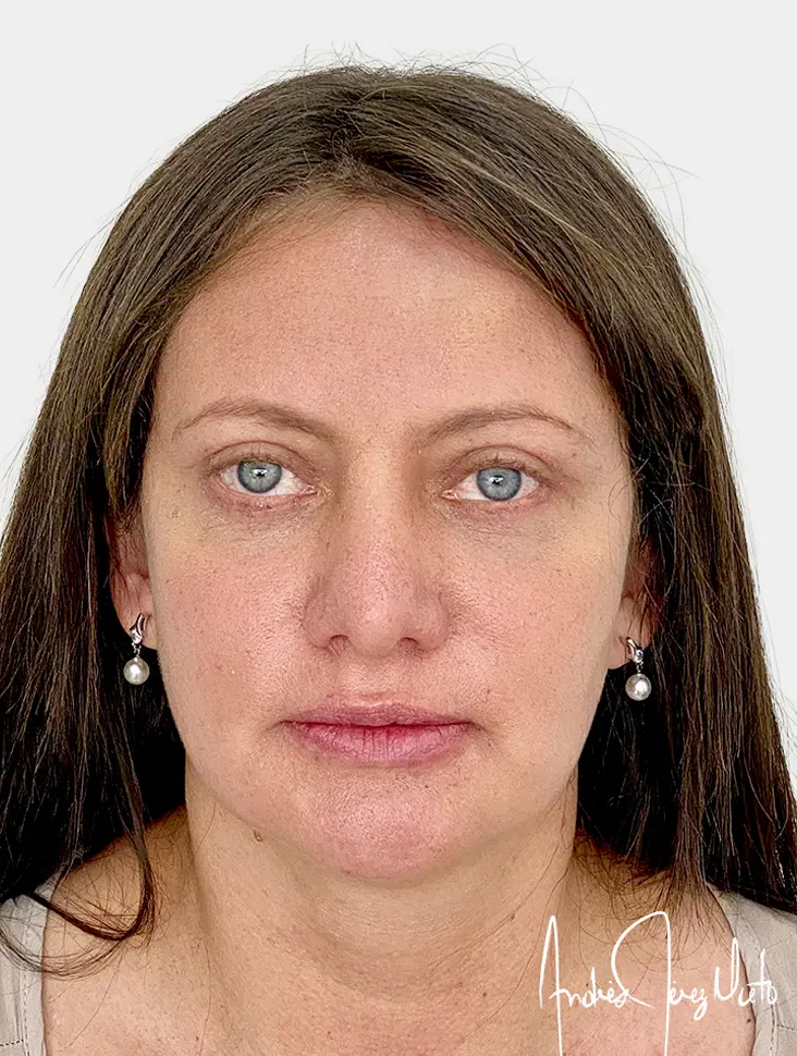 Resultado 2 - Después