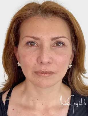 Resultado 1 - DESPUÉS