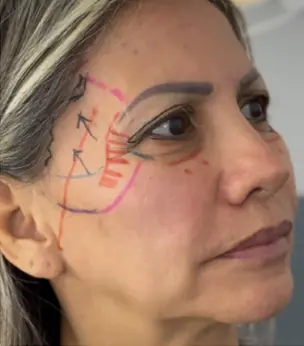 Elevación Temporal Extendida