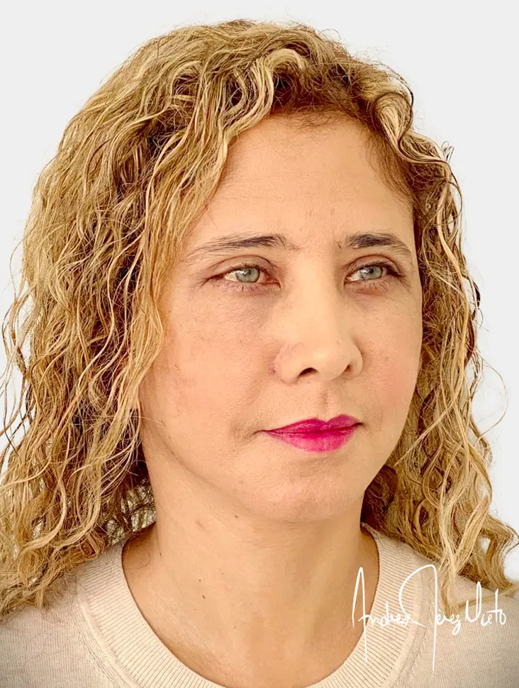 Resultado 1 - Después