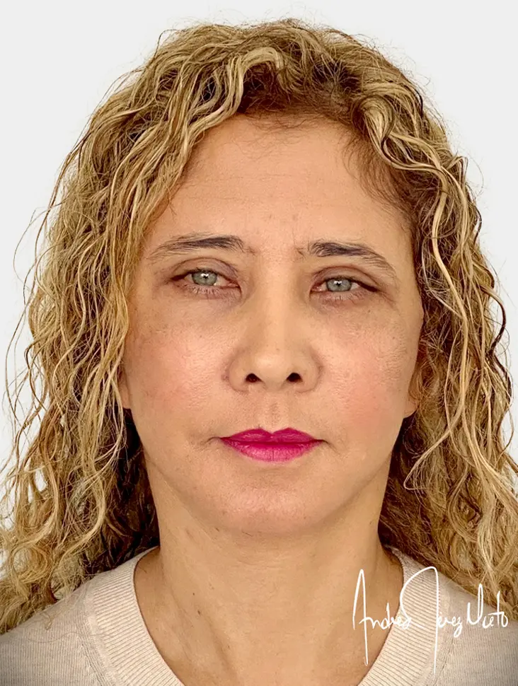 Resultado 2 - Después