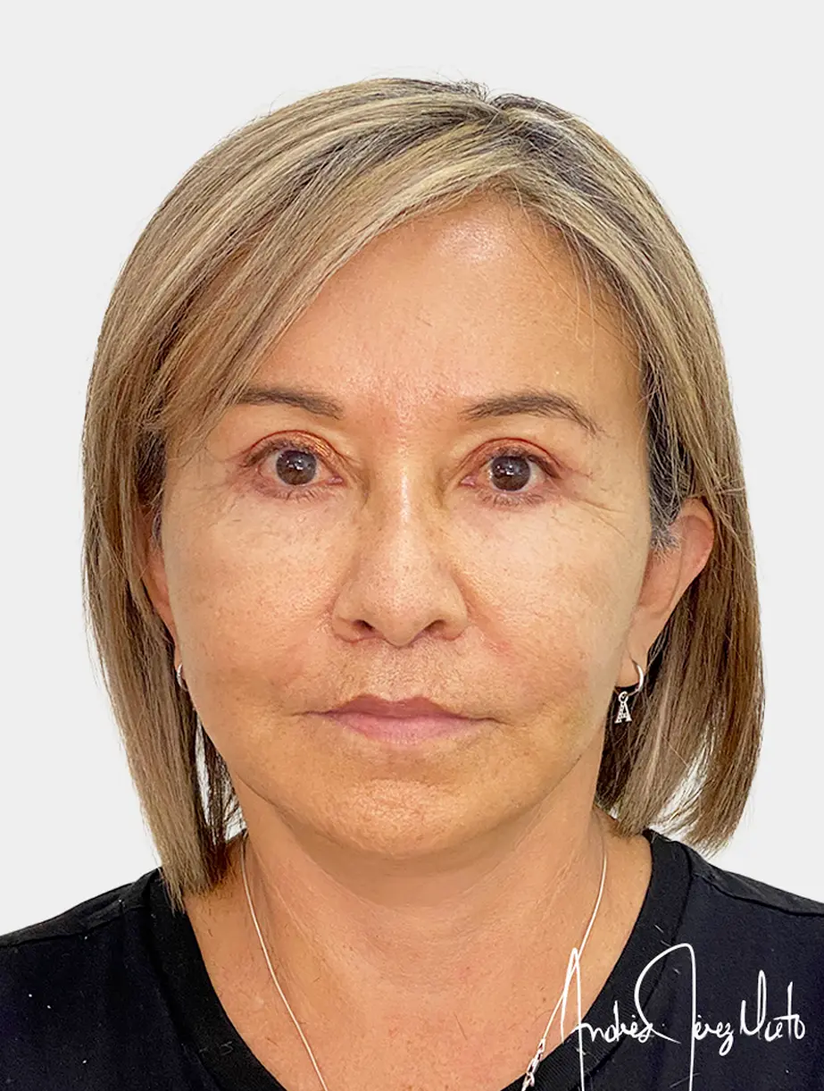 Resultado 1 - Después