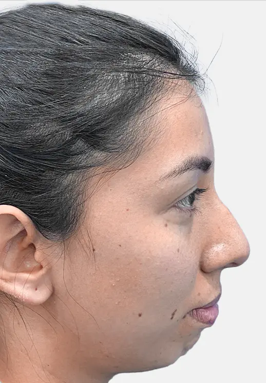 Resultado Mentoplastia 1