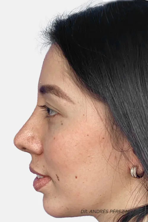 Resultado Mentoplastia 2