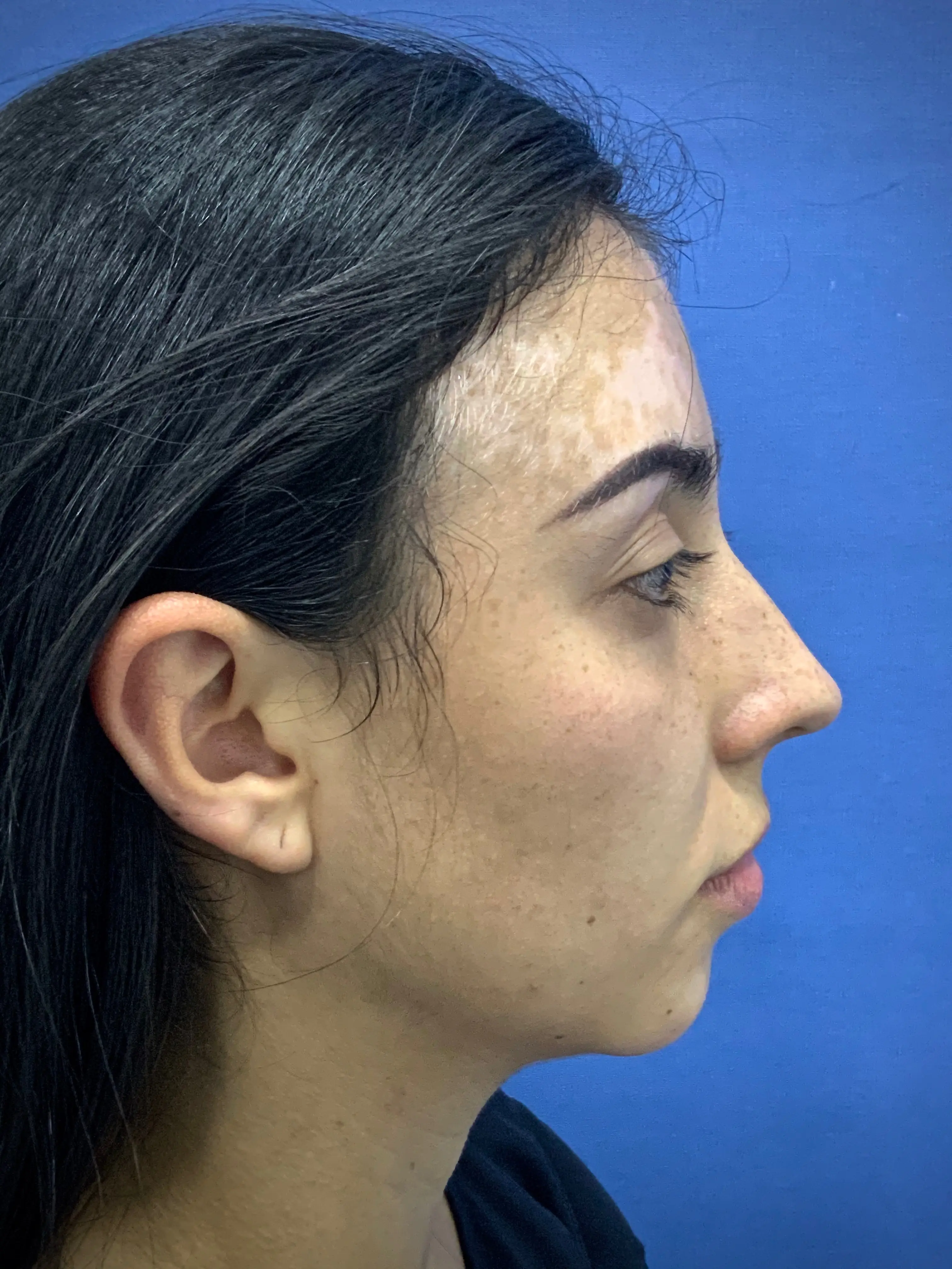 Resultado Mentoplastia 3