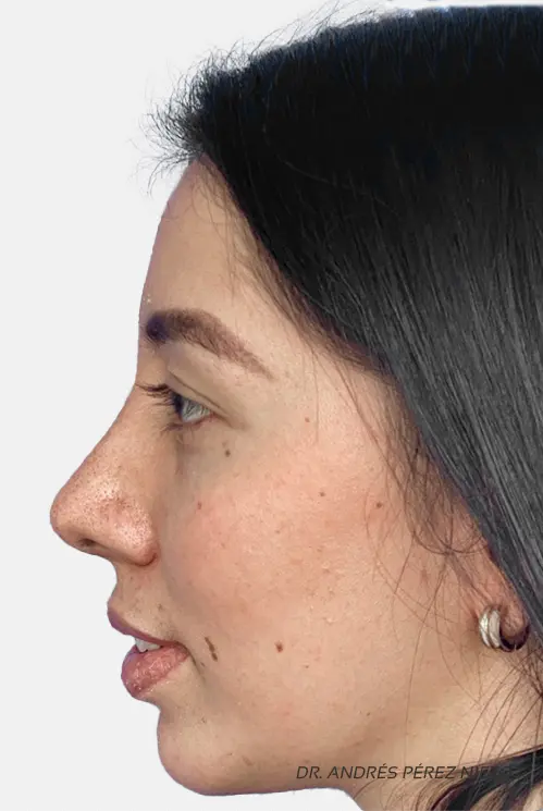 Paciente 1 - Después