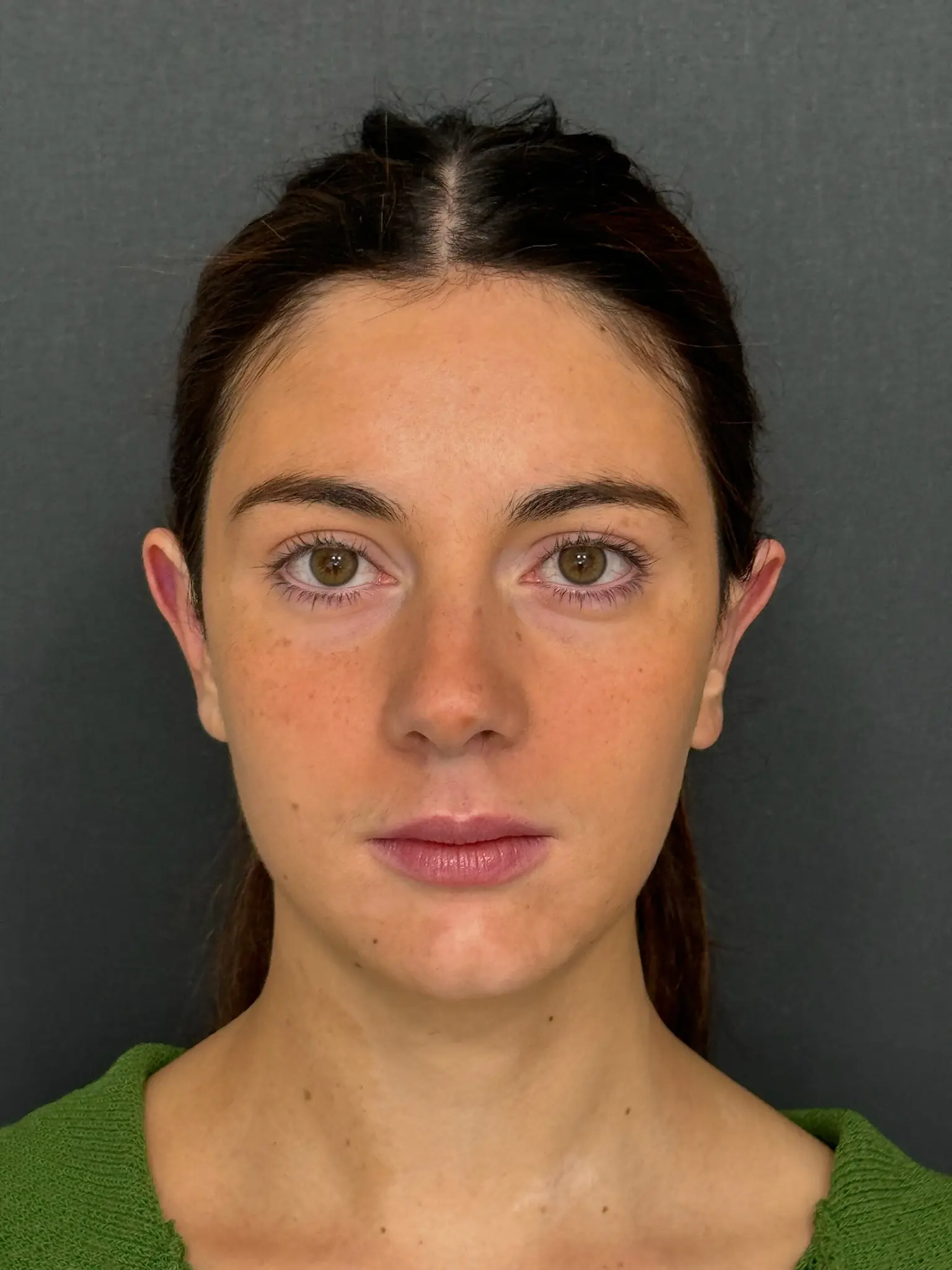 Paciente 1 - Después