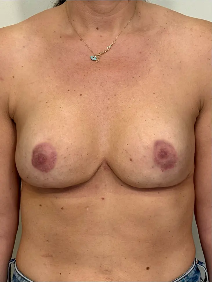 Paciente 1 - Después