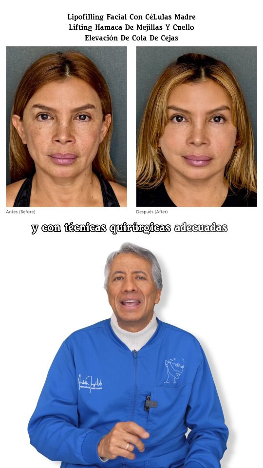¿Hay una edad mínima para un lifting facial?
