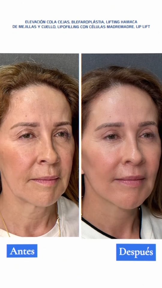 Lifting facial en hamaca: resultado natural en Bogotá