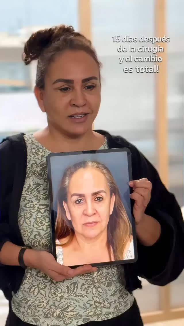 Lifting en hamaca: resultado a 15 días sin efecto estirado