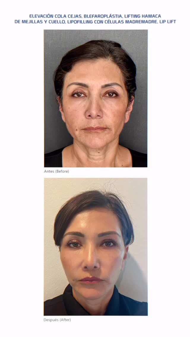 Células madre: elasticidad y brillo real tras lifting facial