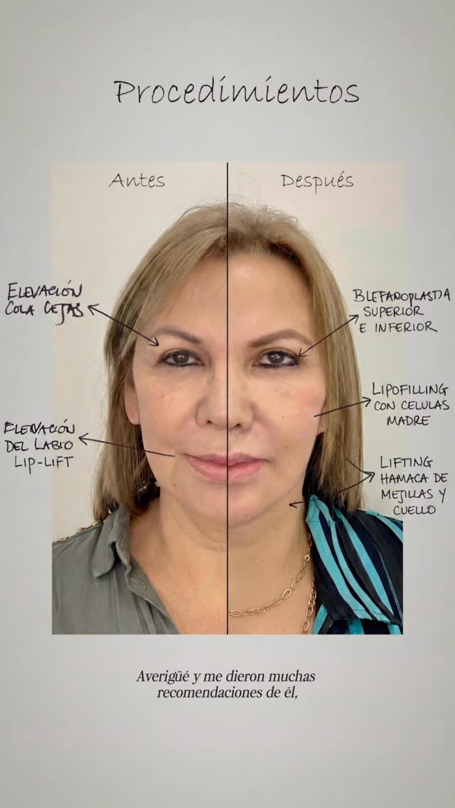 Testimonio real: cómo decidirse por un lifting facial con seguridad