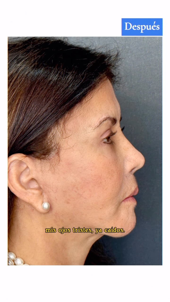 Lifting Facial en Hamaca: resultado natural al mes