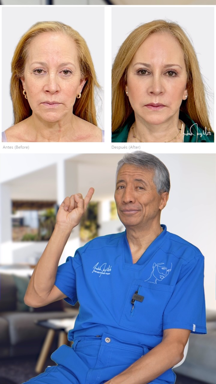 Lifting facial con células madre: resultados más naturales